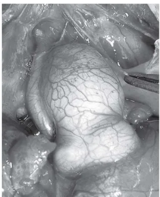 Fig. 1 - Extremely hypoplastic ascending aorta in children with hypoplastic left heart syndrome