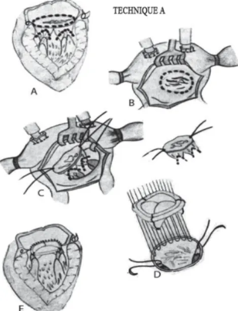 Fig. 2 – Mitral prosthesis with preservation of subvalvular system components: attachment of the papillary muscles and tendinae chordae to the posterior annulus (Évora et al., Braz J Cardiovasc Surg