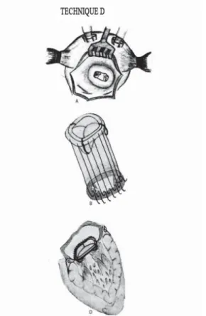Fig. 5 - Mitral prosthesis with preservation of subvalvular system components: partial excision of the anterior leaflet and reduction of the posterior leaflet by keeping their borders as copied from David TE (Ann Thorac Surg