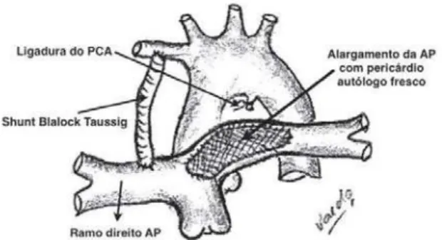 Fig. 3 - View of wide longitudinal enlargement of the area of coarctation of the pulmonary artery using a graft of fresh autologous pericardium with a continuous suture of absorbable  7-0 polydioxanone (PDS) yarn