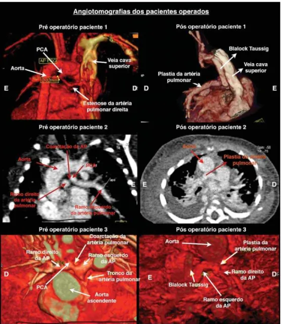 Fig. 4 - View of multidetector CT angiography in patients undergoing surgical correction of coarctation of the pulmonary artery