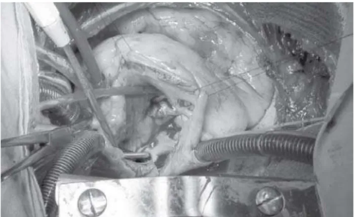 Fig. 2 - There is a large vegetation attached to the ventricular lead into the right atrium without affection of the tricuspid valve  Fig