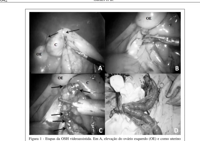 Figura 1 - Etapas da OSH videoassistida. Em A, elevação do ovário esquerdo (OE) e corno uterino (C) por duas suturas de fixação (setas) para visualização do CAVO; em B, a secção parcial do CAVO e ligamento largo uterino após aplicação de clipes proximal e 