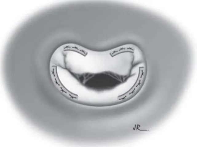 Fig. 1 – Intermittent Annuloplasty: Plications are performed using bovine pericardium strips on the various annulus segments