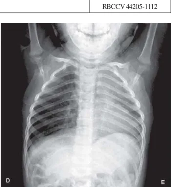 Fig. 1 – Radiografia de tórax com área cardíaca de difícil delimitação devido o desvio das estruturas mediastinais para o hemitórax esquerdo