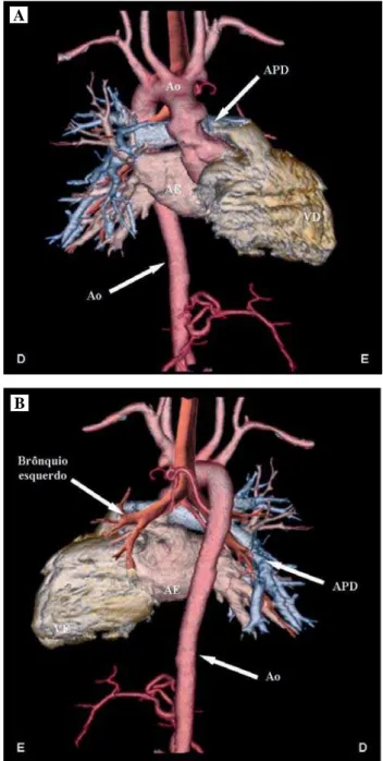 Fig. 2 – A: Tomografia computadorizada de múltiplos detectores em vista anterior demonstrando com clareza a agenesia da artéria pulmonar esquerda