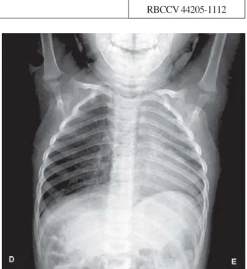 Fig. 1 - Chest radiography with cardiac area with difficult delimitation due to the deviation of the mediastinal structures to the left hemithorax