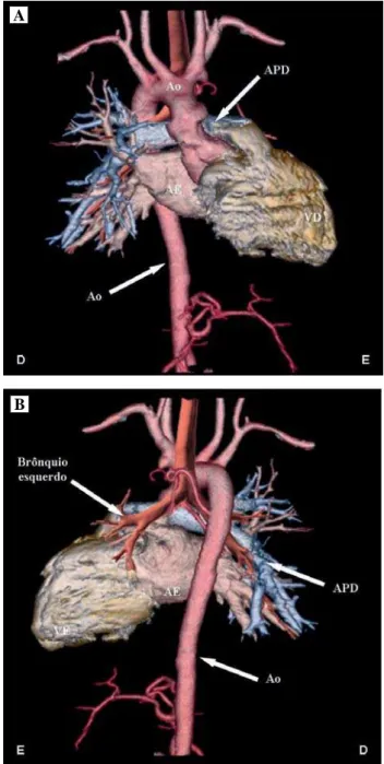 Fig. 2 - A: Multiple detector computed tomography in anterior view showing clearly the  agenesis of the left pulmonary artery