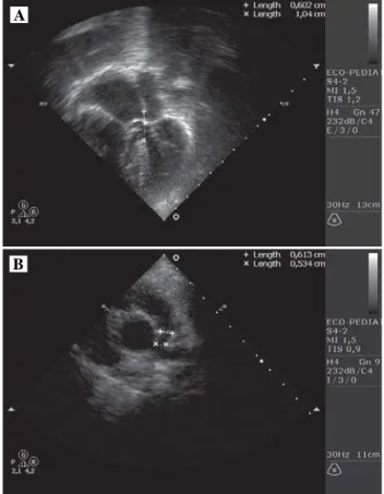 Fig. 3 – Aspecto do coração imediatamente após abertura do esterno. O tronco pulmonar é hipoplásico e o átrio direito e ventrículo direito mostram-se distendidos.