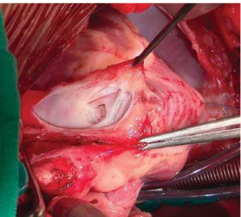Fig. 5 – Ampliação da via de saída do ventrículo direito com placa de pericárdio bovino.