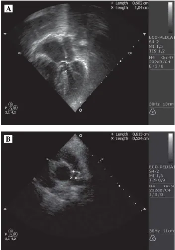 Fig. 3 – Aspect of the heart immediately after opening the sternum.