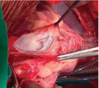 Fig. 5 – Enlargement of the right ventricle outlet tract with bovine pericardium patch.