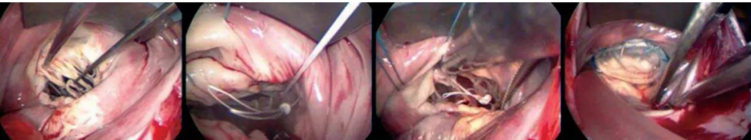 Fig. 3 - Identificação da ruptura de cordas para cúspide anterior da valva mitral, implante de loops de Gore-Tex®, sua fixação no músculo papilar e cúspide anterior e aspecto final da plastia valvar
