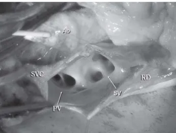 Fig. 3 – Surgical appearance showing bovine pericardial patch (BP) completely closing the interatrial defect and directing the anomalous pulmonary veins to the left atrium