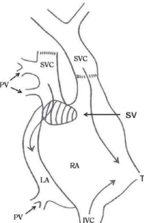 Fig. 5 – Procedure on which the superior vena cava is sectioned above the outflow of the highest anomalous pulmonary vein and the distal or cephalic stump is anastomosed in the right atrial appendage