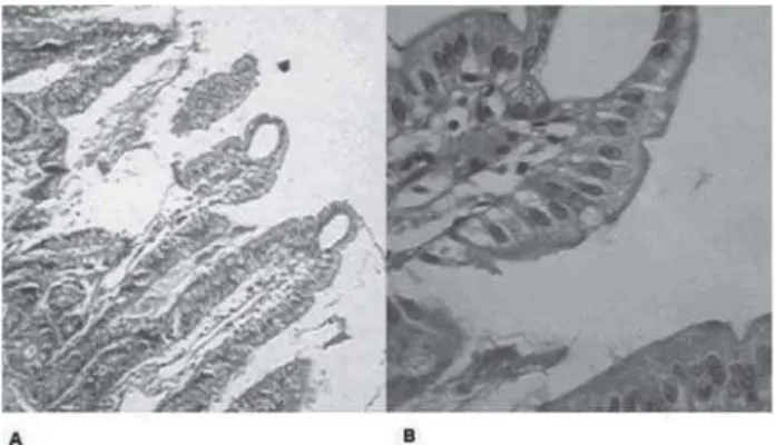 Fig. 5 – Photomicrography of the 3 degree according to Chiu et. al.