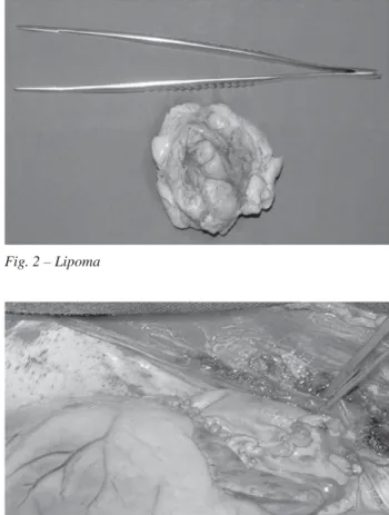 Fig. 1 – Preoperative echocardiogram with visualization of mass in  the right atrium