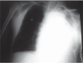 Fig. 2 – Chest radiography with partial opacification of the whole left hemithorax; disappearance of the cardiac silhouette and mediastinal structures; with deviation of the trachea to the left