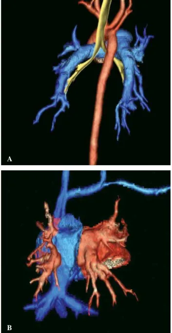 Fig. 2 – Radiografias de tórax: (A) Frente em PA com dextrocardia e aumento de área cardíaca