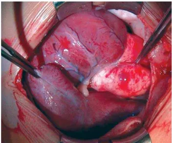 Fig. 4 – Atrium positioned to the left being pulled by the forceps and with external anatomical characteristics that resemble the right atrium