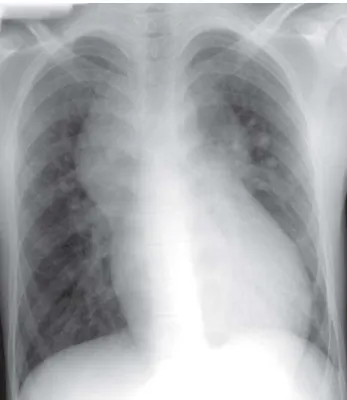 Fig. 1 - Chest radiography in postero-anterior, showing heart format resembling a “snowman”