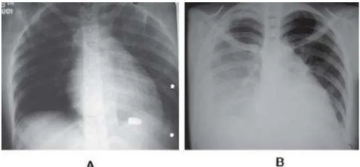 Fig. 2 – Chest radiographies show the change of bullet position and right pleural effusion