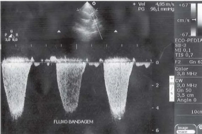 Fig. 3 – Traçado de Doppler contínuo mostrando gradiente sistólico pela bandagem do tronco pulmonar de 98 mmHg