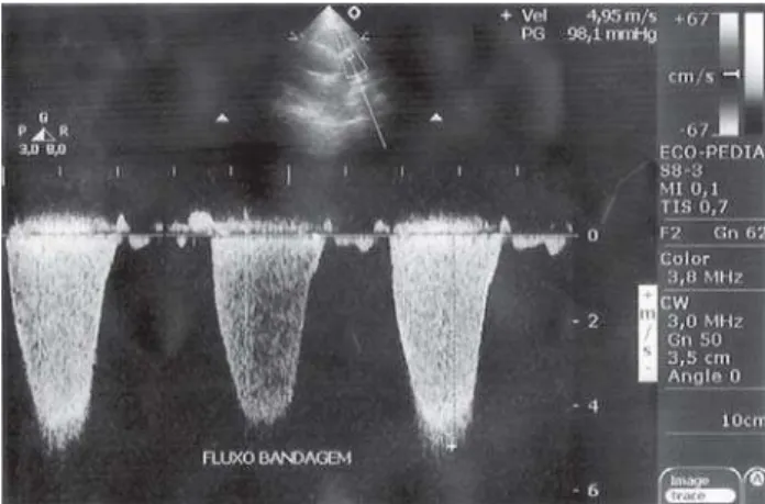 Fig. 3 – Trace of continuous Doppler showing systolic gradient by banding of the pulmonary trunk of 98mmHg