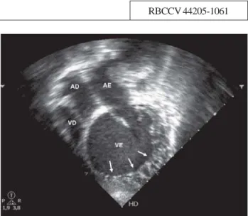 Fig. 1 – Corte apical quatro câmaras demonstrando o ventrículo esquerdo dilatado com trabeculações exuberantes nas paredes lateral e apical (setas,) caracterizando miocárdio não-compactado