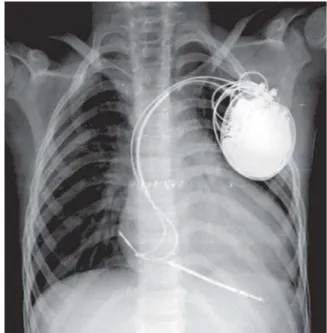 Fig. 3 – Primeira desfibrilação ventricular com 15 J sem sucesso.