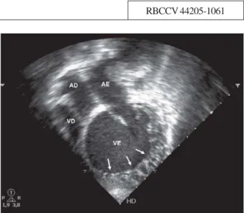 Fig. 1 - Apical four-chamber view showing dilated left ventricle with exuberant trabeculation in lateral and apical walls (arrows,) featuring noncompacted myocardium