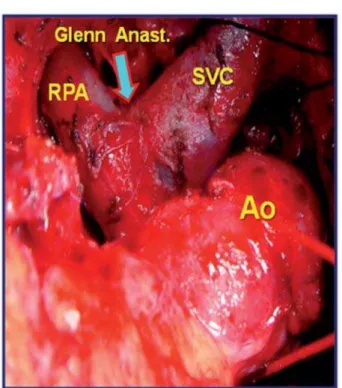 Fig. 3 - Surgical image shows: patient on cardiopulmonary bypass, after atrial approach we observed a large atrial septal defect (ASD).