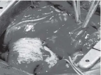 Fig. 2 - (a) Transection of great vessels at the level of aortopulmonary window with both the coronaries mobilized on a single button in continuity with the window