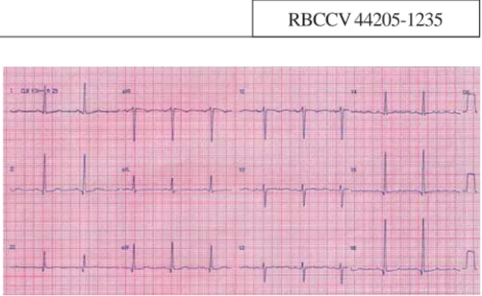 Fig. 1 – Eletrocardiograma pré-operatório com sobrecarga ventricular esquerda