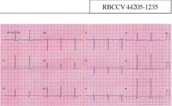 Fig. 1 – Eletrocardiograma pré-operatório com sobrecarga ventricular esquerda