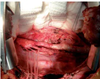 Fig. 3 – Aortic segment compromised after extensive aortic dissection. It is noted the presence of intercostal arteries repaired with cotton thread