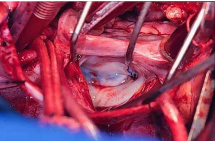 Fig. 1 - Aortic cannula position. The cannula was fixed in a column of towels to avoid kinking position