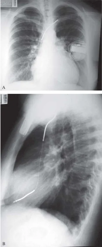 Fig. 1 - A: Chest radiograph in the anteroposterior position (A) and lateral (B), showing the position of the electrode leads of the ICD implanted through the left cephalic vein