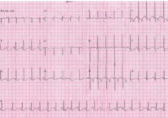 Fig. 1 – Eletrocardiograma pré-operatório com importante sobrecarga ventricular direita