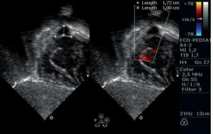 Fig. 2 – Radiografia de tórax pré-operatória com área cardíaca dentro dos limites de normalidade