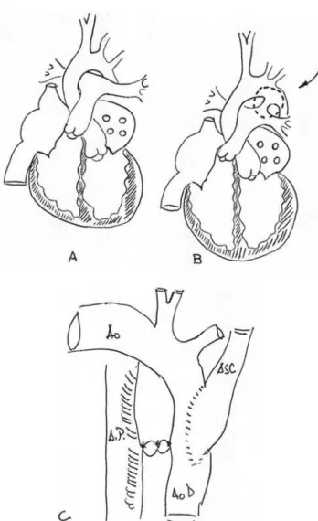 Fig. 1 - Drawings of Danton Rocha Loures. A) Normal heart, B) Persistence of ductus arteriosus; C) Technical correction of coarctation of the aorta with ligation of patent ductus arteriosus