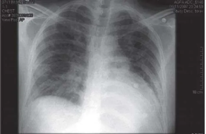 Fig. 1 - A significant pulmonary venous congestion, particularly in the peri-hilar region of both lung fields, and with a moderate enlargement of cardiac silhouette