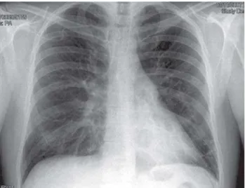 Fig. 5 - A normal pattern of lung field vasculature with a slight enlargement of the cardiac silhouette
