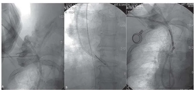 Fig. 3 - A – Catheter proximal end located in the right innominate vein and the distal end located in the inferior vena cava.