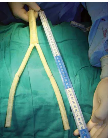 Fig. 5 - Postoperative control CT scan with in situ aortobifemoral reconstruction