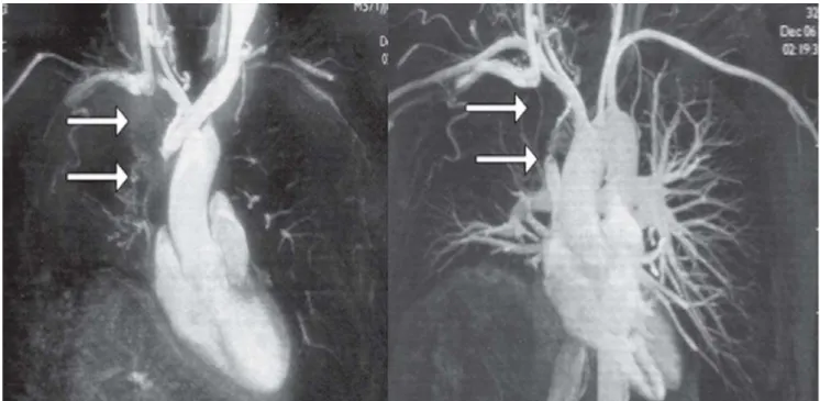 Fig. 1 - Images of the arterial and venous angioresonance of the thoracic vessels. The arrows indicate occlusion of the superior vena cava and the right innominate caused by a mildly heterogeneous mass located in the middle and anterior mediastinal