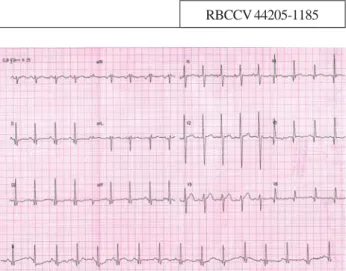 Fig. 1 – Eletrocardiograma pré-operatório