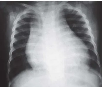 Fig. 3 – Ecocardiograma pré-operatório modo unidimensional demonstrando as medidas da cavidade ventricular esquerda (VE).