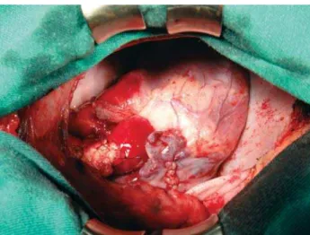 Fig. 5 - left ventricular cardiac muscle tissue with trabeculae of striated muscle cells arranged in interspersed vascular slits, characteristic of myocardial non-compaction