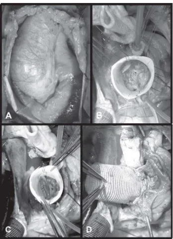 Fig. 2 - Intraoperative images. A. The ascending aortic aneurysm.